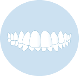 出っ歯 （上顎前突）